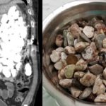 Stones from guts